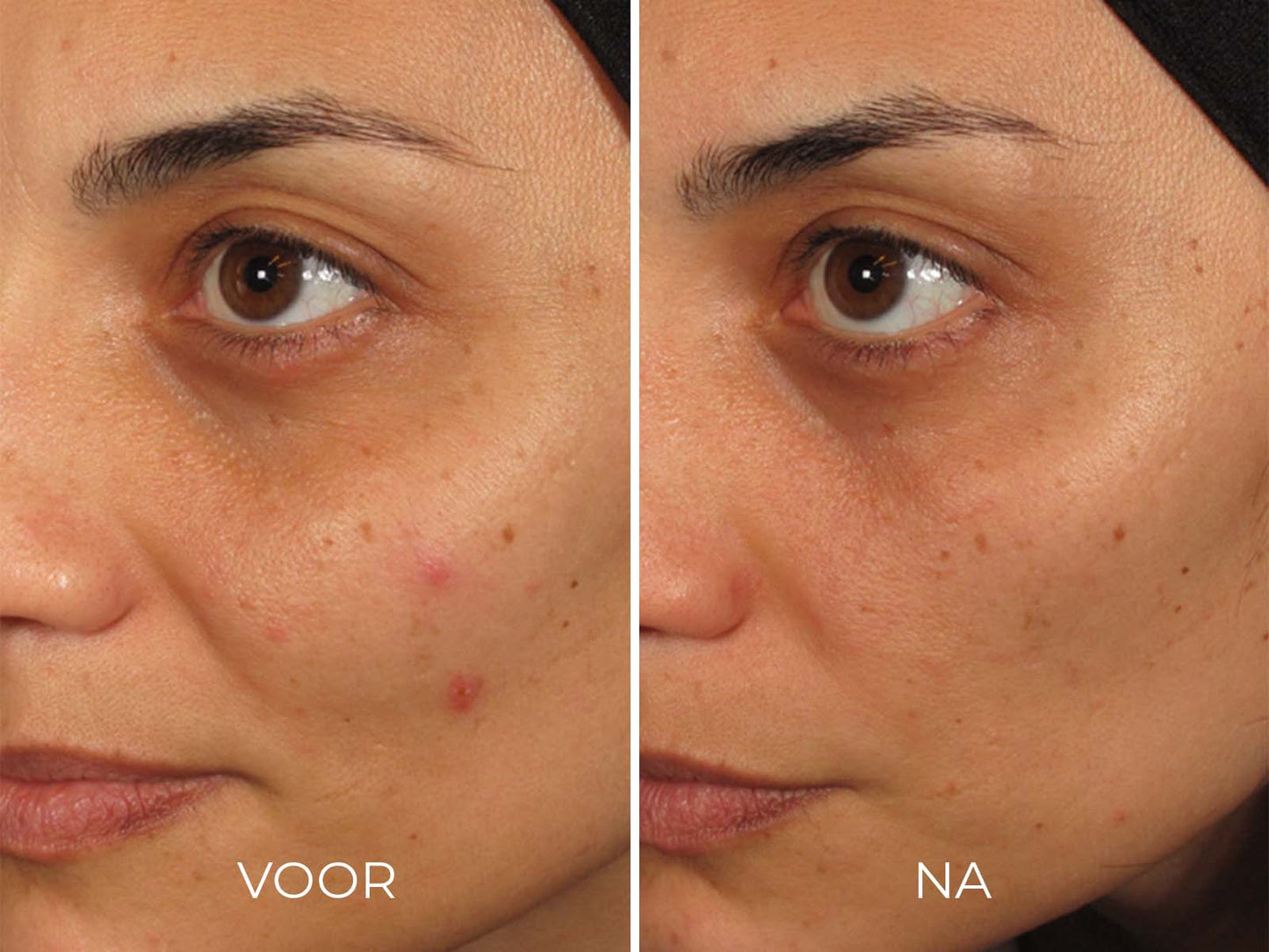 Image | ILUMA - Intense Facial Illuminator - Delizia Skincare