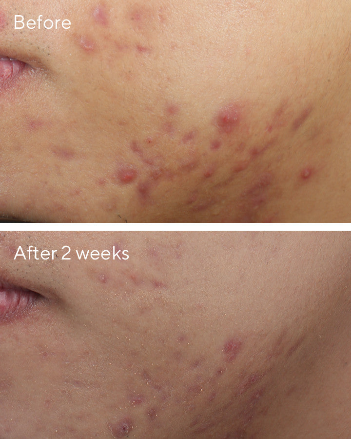 Murad | Deep Relief Blemish Treatment