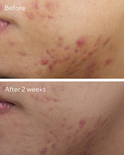 Murad | Deep Relief Blemish Treatment