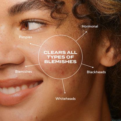 Murad | Biome-Balancing Clear & Prevent Blemish Treatment Serum