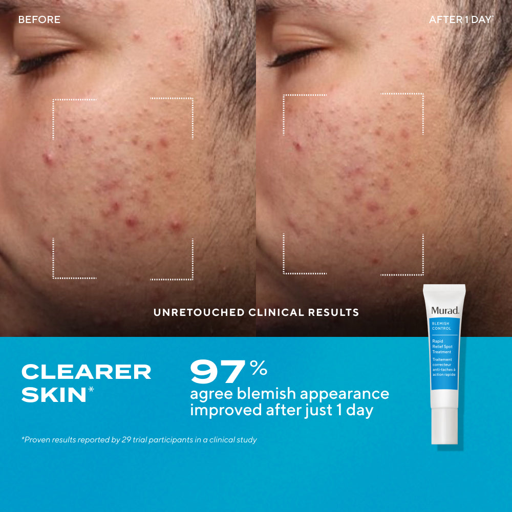 Murad | Blemish Control Kit