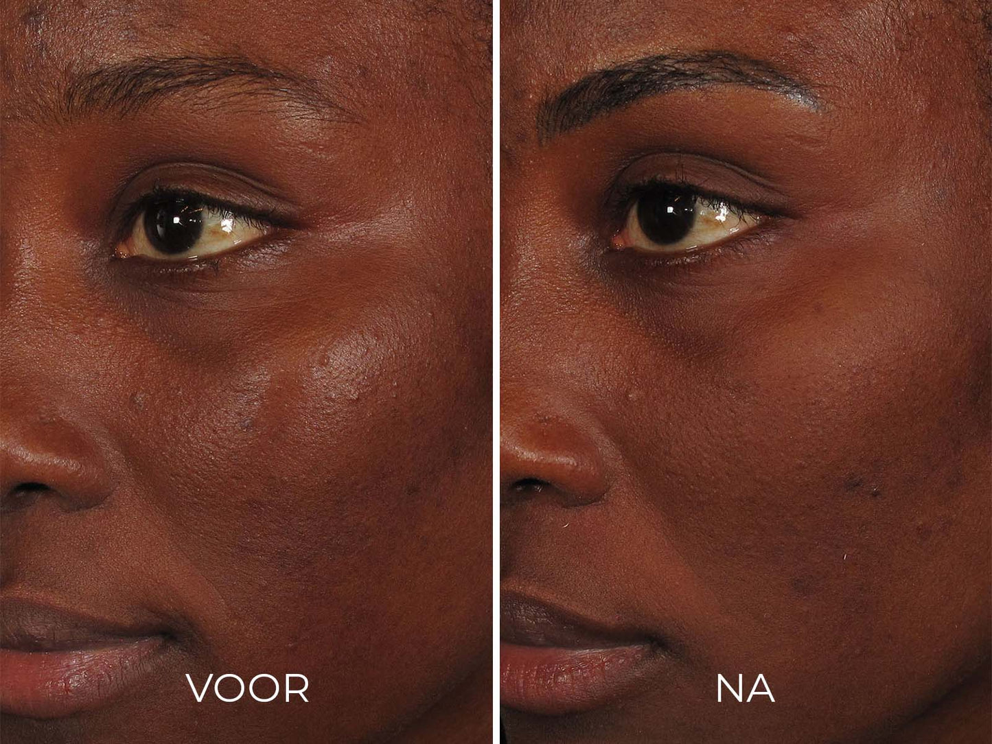 Image | ILUMA - Intense Facial Illuminator - Delizia Skincare